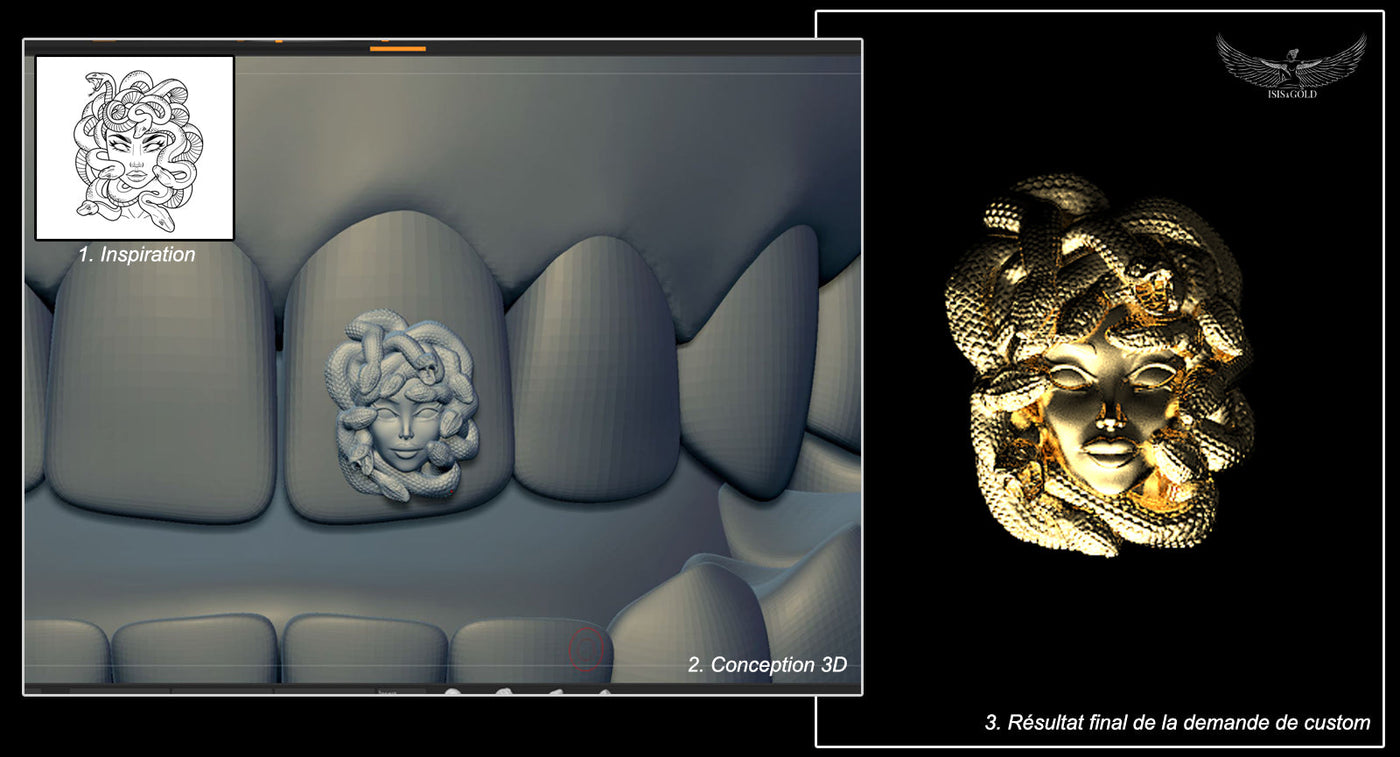 Gold grillz: complete guide to types, prices, and custom options