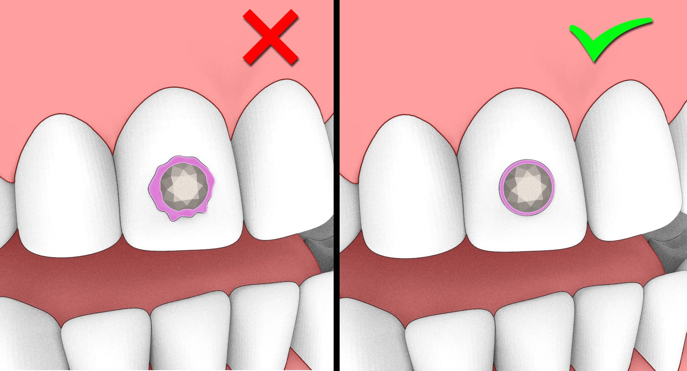 10 common mistakes when applying a tooth gem (and how to avoid them)