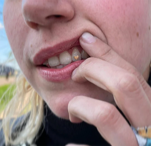 gold tooth gems heart